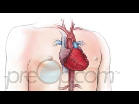 Vídeo: Angioplastia Cardíaca Y Colocación De Stent