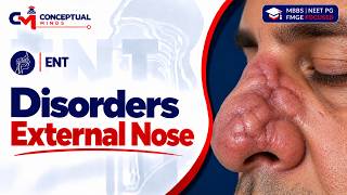 66. Disorders of the External Nose | Nasal Infections, Deformities, Trauma & Treatment | ENT screenshot 5