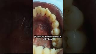 इतना मैल दाँत में? 😳 Full Teeth Cleaning Video | Scaling Treatment”