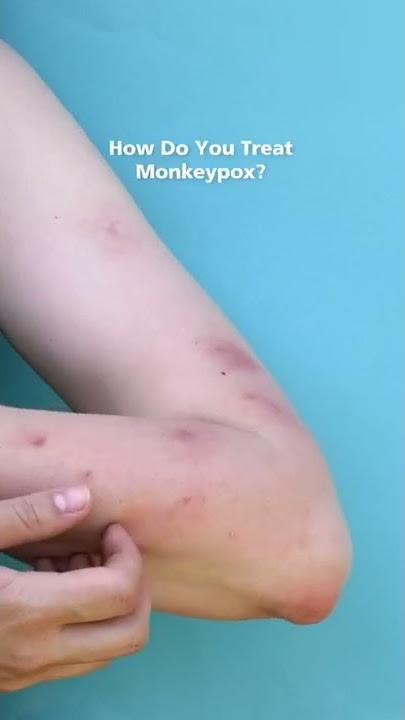 ATTN: 📣 Monkeypox outbreaks have been on the rise