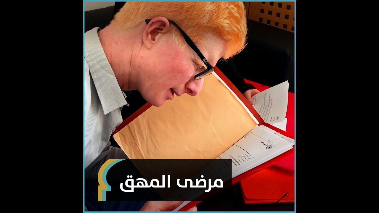 اضطراب خلقي غير مظهرهم الخارجي: قصص مصابين بمرض المهق