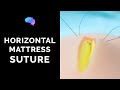 Horizontal Mattress Suture - OSCE Guide