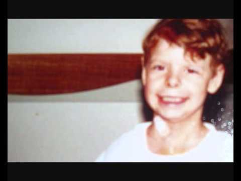Image Result For Williams Syndrome Image Result For Williams Syndrome