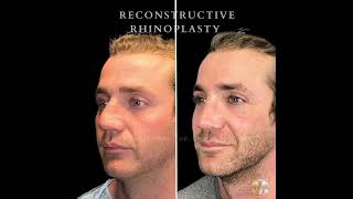 Reconstructive Rhinoplasty By Dr. Michael Omidi