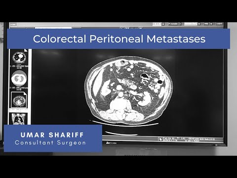 Video: Betydningen Av Synkronitet I Håndteringen Av Kolorektal Peritoneal Metastaser Med Cytoreduktiv Kirurgi Og Hypertermisk Intraperitoneal Cellegift