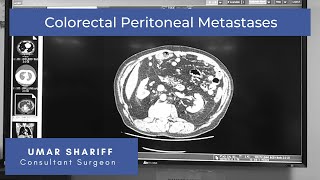 Colorectal Peritoneal Metastases (CPM): Key facts