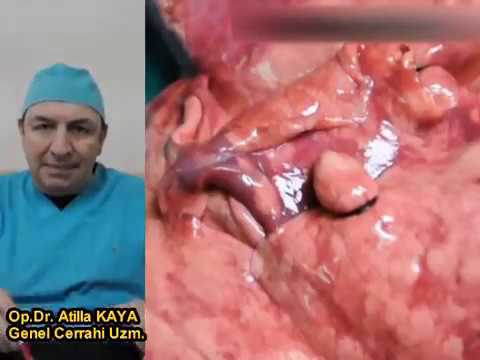 Modern tıpta hemoroid nasıl tedavi edilir Modern tıpta hemoroid nasıl tedavi edilir
