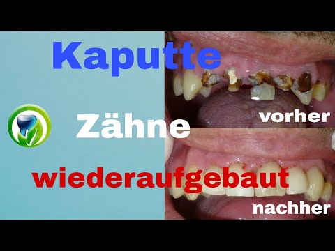 Video: 3 Möglichkeiten, faulende Zähne zu reparieren