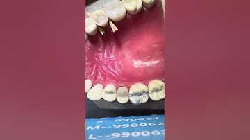 Composite restoration on 25, part 7