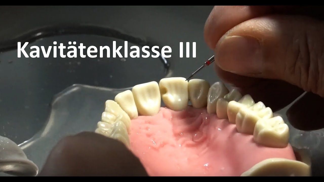 Teil 1 - Kavitätenpräparation für Komposit I: Frontzahnbereich [4K]