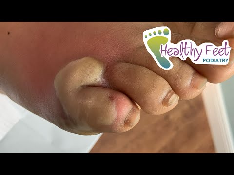 Video: Infected Blister: Hur Man Kan Veta Om Det är Infekterat, Behandling Och Bilder