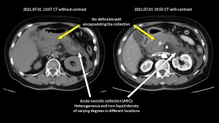 壞死性胰臟炎案例分享 (Necrotizing Pancreatitis)