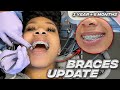 Finally Getting POWER CHAINS On My Braces After 1 Year & 6 Months! | Braces Vlog UPDATE! | KDiani