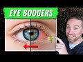 How To Get Rid Of Eye Boogers And Crust (3 Causes and Treatments)