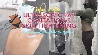 Ultrasonic Fat Cavitation & Laser Lipo Before and After Review (What I Learned After 5 Sessions)