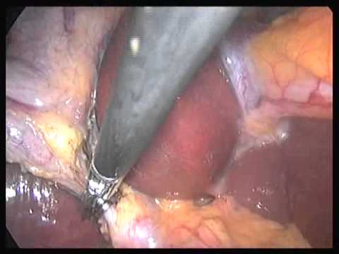 Laparoscopic Cholecystectomy -Laser Gastro Clinic