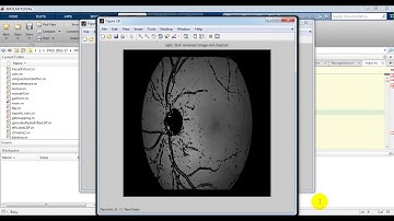 Retinal Disease Screening through Local Binary Patterns || best projects center at Bangalore