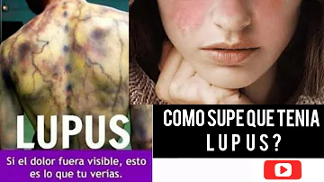 ¿Cómo supo que tenía lupus?