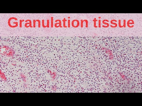 Video: Hva er granulering av sår?