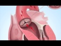 Understanding Aortic Stenosis with Dr. Marc Gillinov