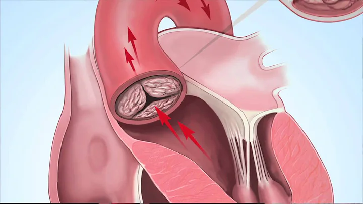 Understanding Aortic Stenosis with Dr. Marc Gillinov - DayDayNews