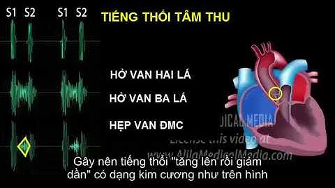 TIẾNG TIM VÀ TIẾNG THỔI TIM | VUTM ôn thi modul tim mạch