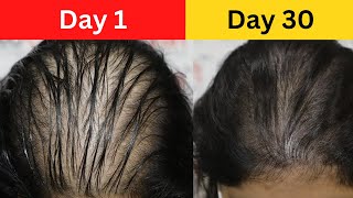 बाल धोने से पहले ये लगा लो इतना गजब का Result आएगा World&#39;s Best Onion Juice for Hair Regrowth Mask