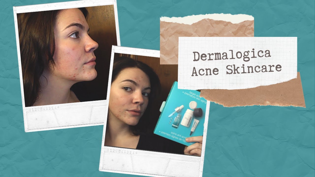 Dermalogica active clearing, can this clear my acne? | Literally Cheyenne