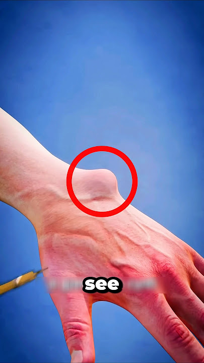 Don't POP That LUMP on Your Hand #shorts