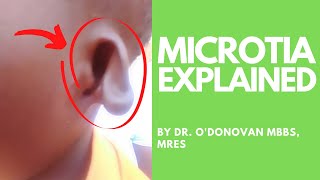 Explaining Microtia (an abnormally shaped ear) with Dr O'Donovan