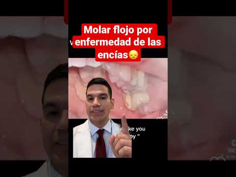 Video: ¿Deberías forzar la extracción de un diente flojo?