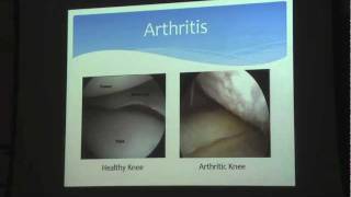 Total Knee Replacment Maximizing Your Results Dr. Eric Janssen