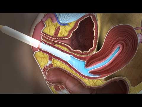 Video: Jak se připravit na intravaginální ultrazvuk: 13 kroků