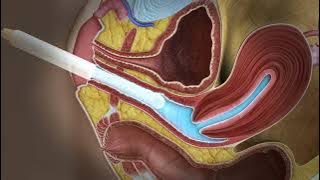 Transvaginal ultrasound exam: how it works