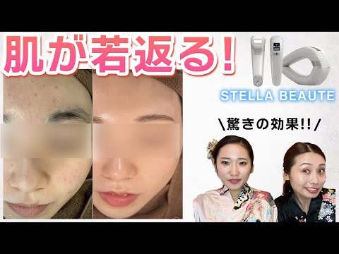 ニキビが消えた！】脱毛して美肌に！ステラボーテ脱毛器 - YouTube