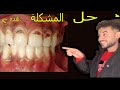 تسوس عنق الأسنان 