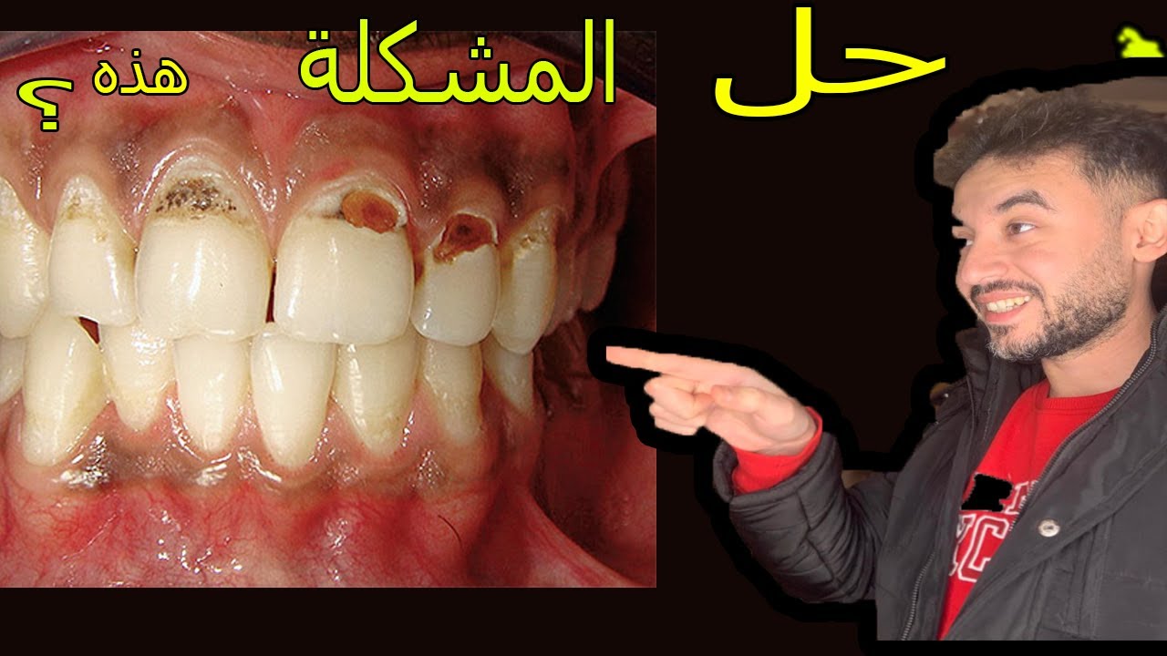 تسوس عنق الأسنان