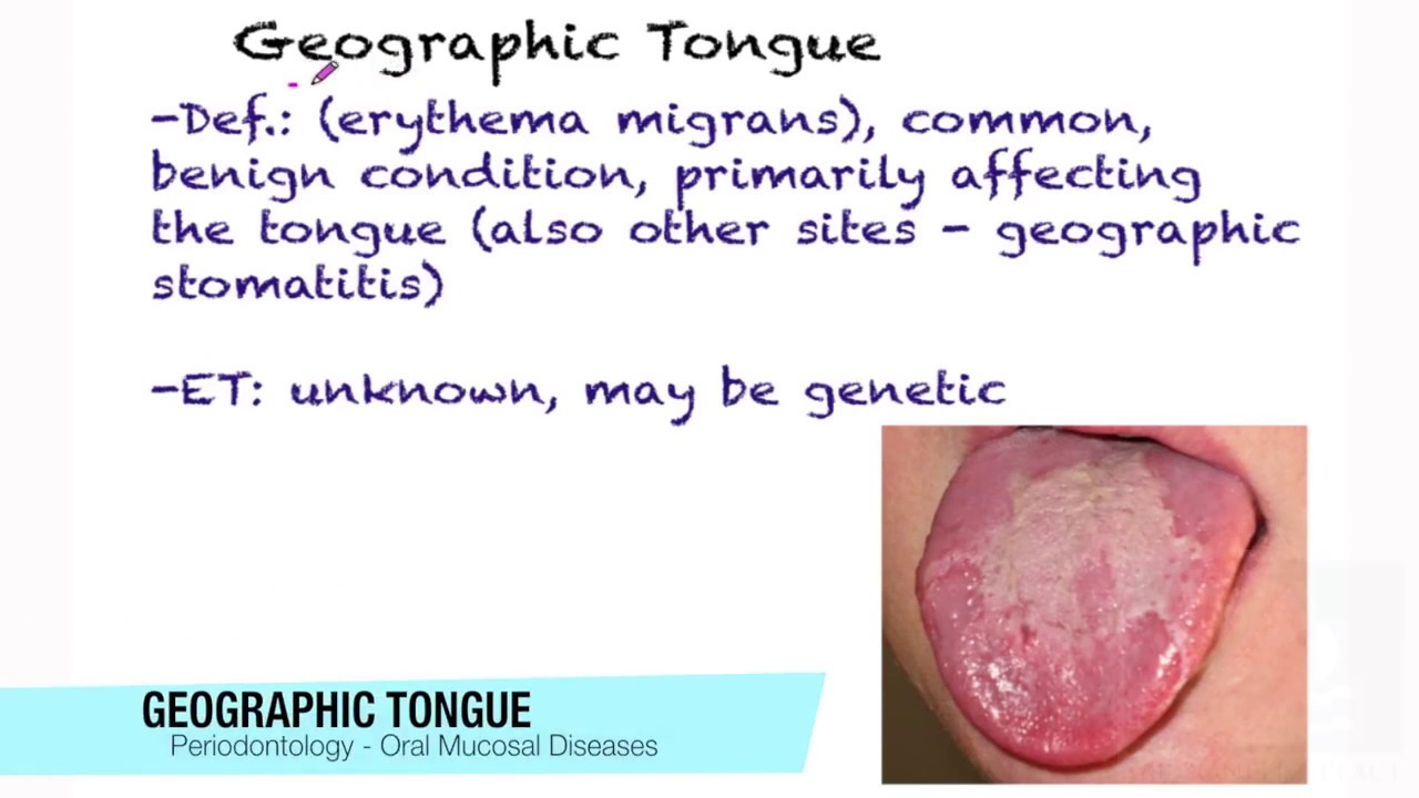 Benign Tongue Lesions