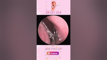 The secret to suctioning nose, runny nose removal