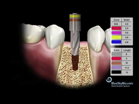 BIO | Max Safety Stop Drill Kit Video (4.3mm Implant)