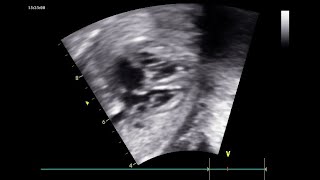 DIU 2020 B STOS Cardiologie foetale