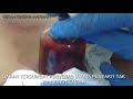 Bekam mempercepat regenerasi sistem darah. tubuh sakit kembali pulih