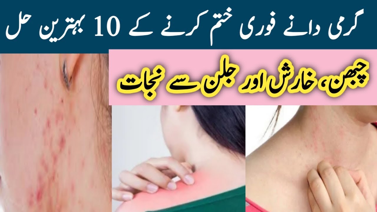 Garmi Dane Khtam karny Ka tareka Garmi dano Ka ilaj How to Treat