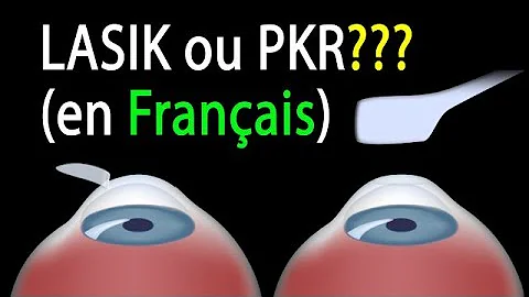 Quelle est la différence entre le laser et le LASIK