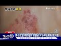 突然發紅 持續性神經刺痛 長水泡 醫警告 罹這病 痛不欲生 十點不一樣20231018 TVBSNEWS01 突然發紅 持續性神經刺痛 長水泡 醫警告 罹這病 痛不欲生 十點不一樣20231018 TVBSNEWS01