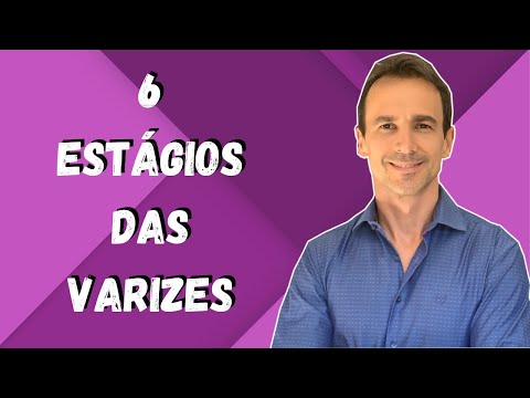 Vídeo: Varizes Das Extremidades Inferiores: Sintomas, Tratamento, Prevenção, Estágios