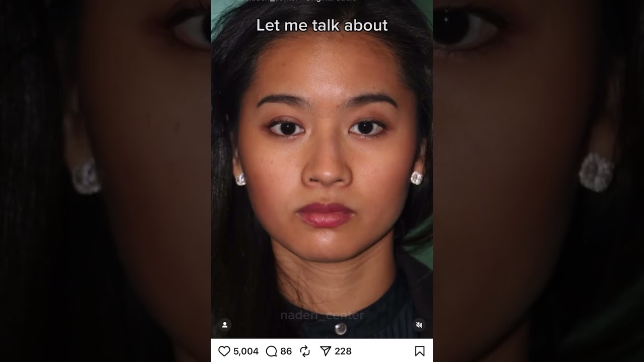 Rhinoplasty patient of Dr. Shervin Naderi, before and after video