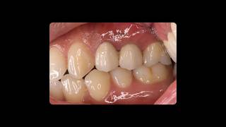 #Rerct#gingivectomy#fiberpost#composite #pfm #endo