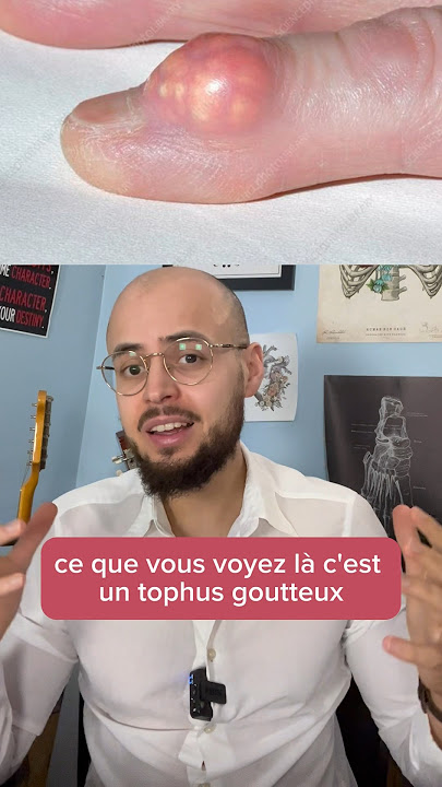 Le caséum donne une très mauvaise haleine 🤢 #haleine #caseum #bouche