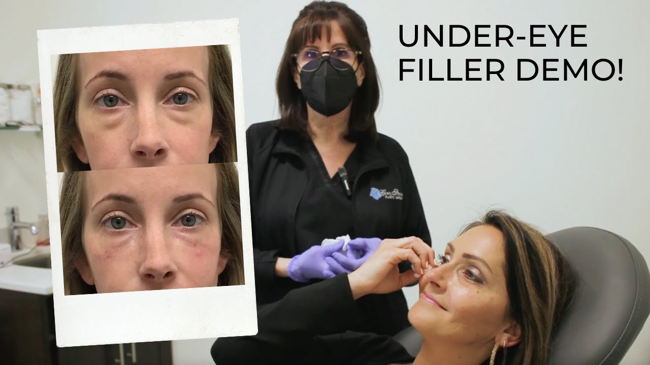 Get Rid of Dark Under-Eyes | Tear Trough Filler Demo